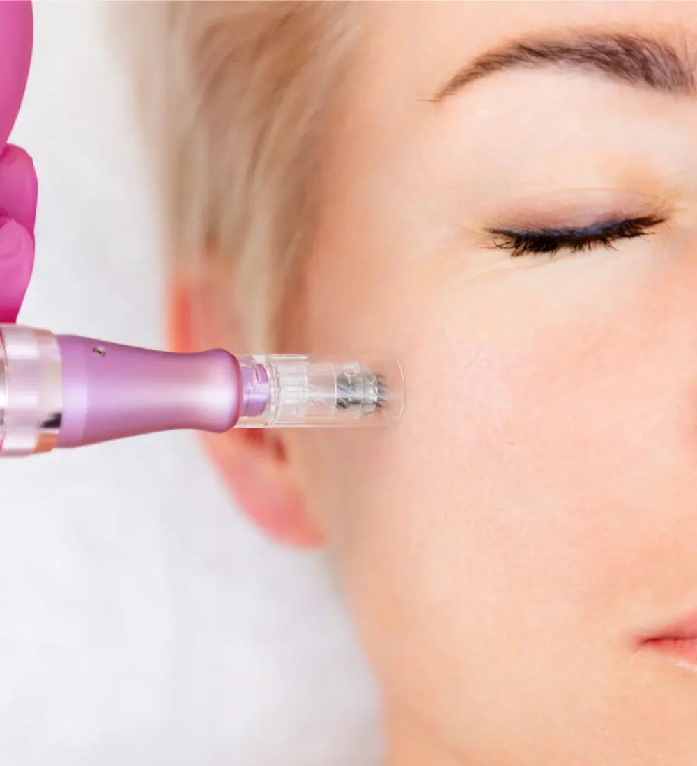 Dermastamp Microneedling (2)