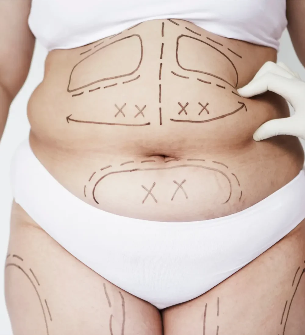 Liposuction